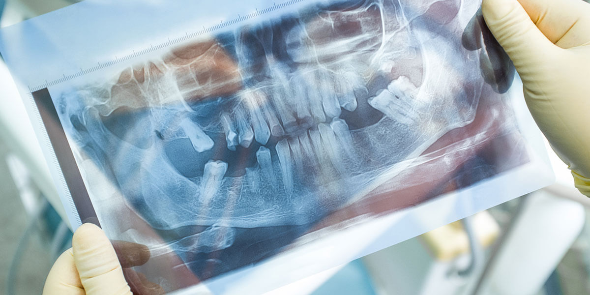 Bone-Grafting-Page.jpg Bone-Grafting-Page.jpg